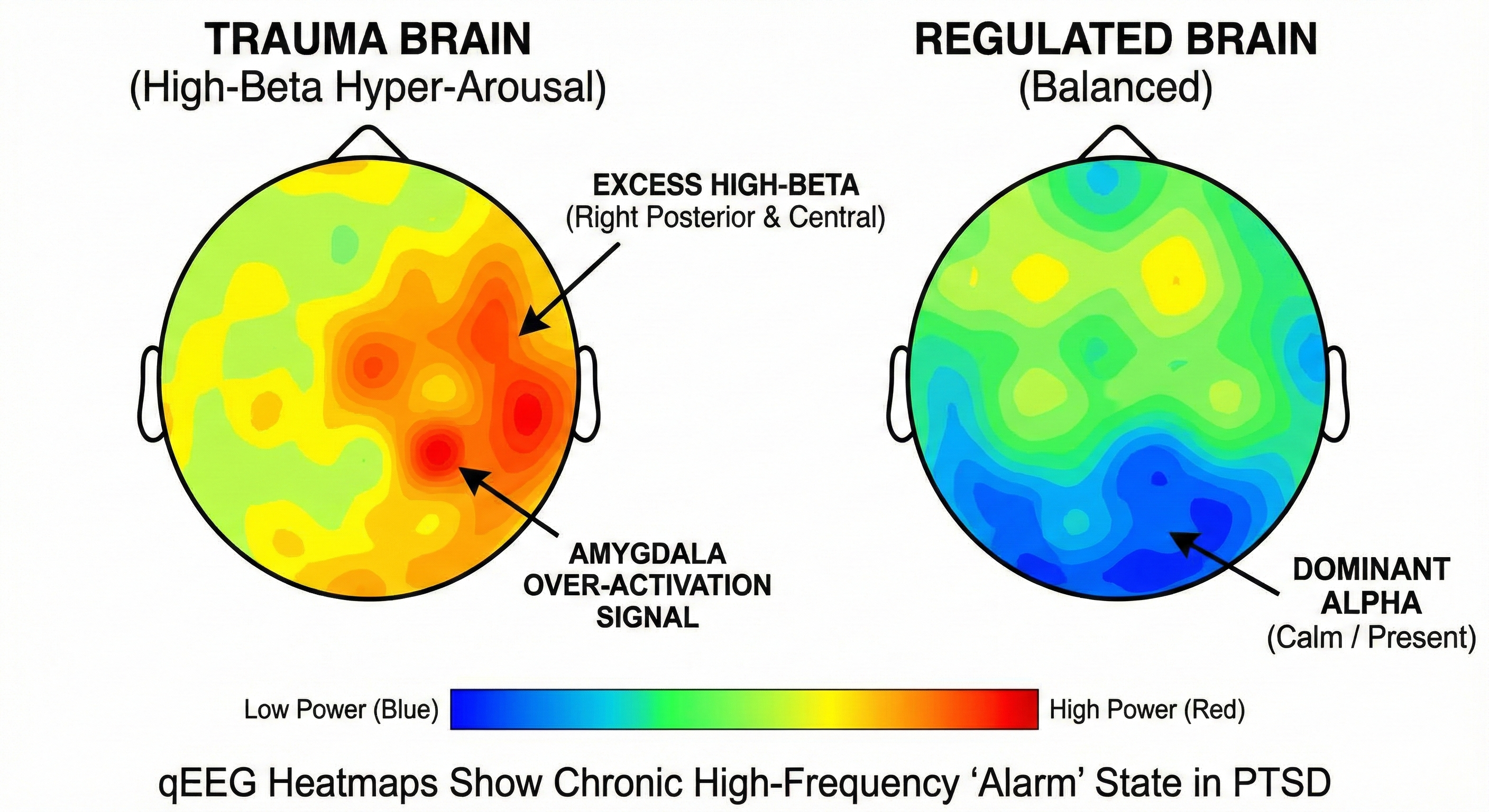 qEEG brain mapping for PTSD using the 10-20 system